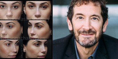 Liquid Nose Jobs with Dr Sykes